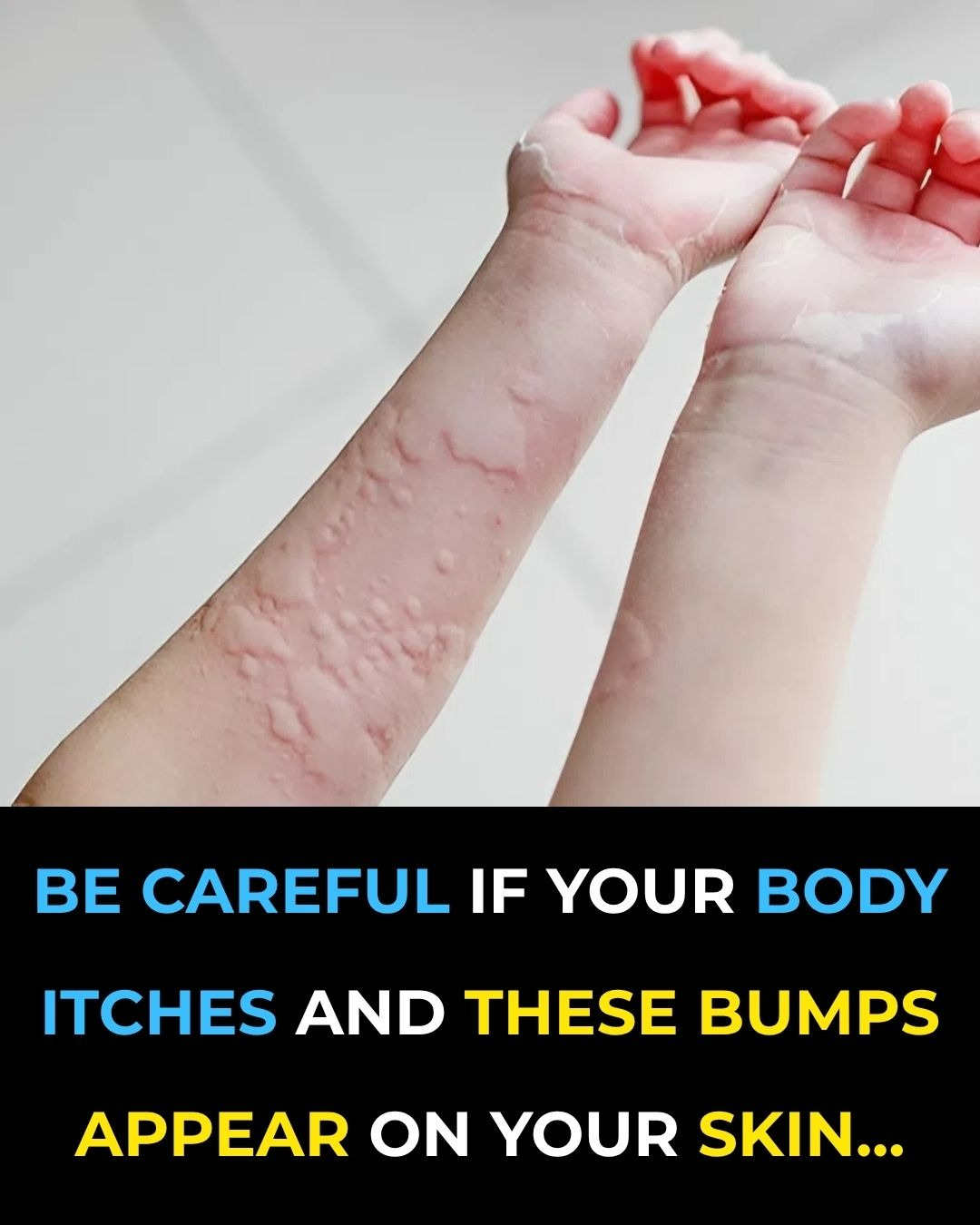 Unexpected Triggers Behind Hives — Could This Be Affecting Your Skin