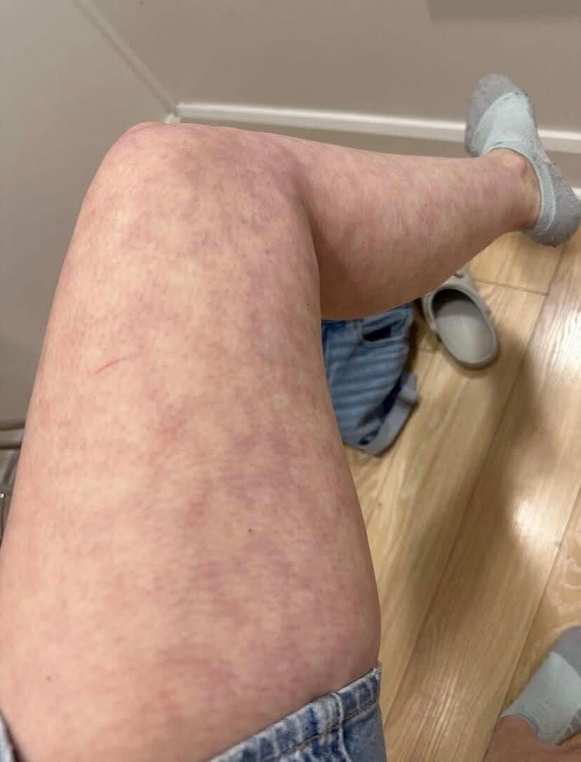 Understanding Livedo Reticularis: What Your Skin May Reveal