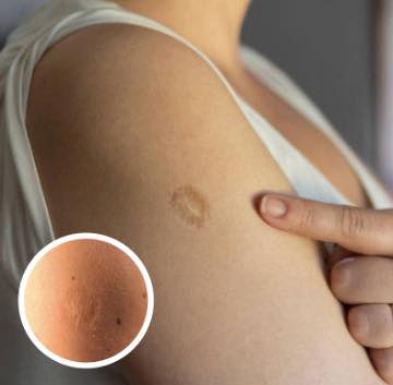 What That Upper-Arm Scar Really Means