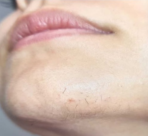 What Chin Hair Could Mean for Women’s Health