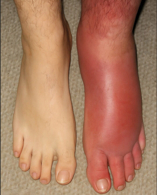 Sudden Red, Swollen Leg: What It Could Mean