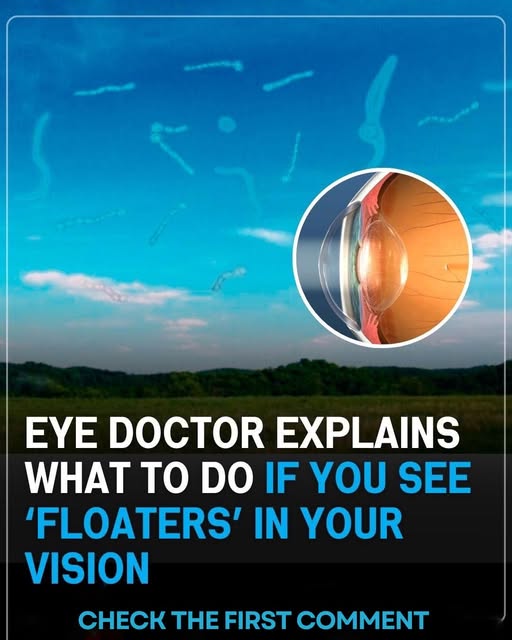 Eye Floaters: What Those Shadows Really Mean