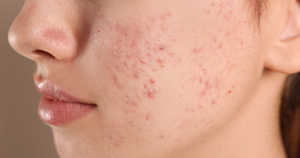 Understanding Chin Breakouts and Their Causes