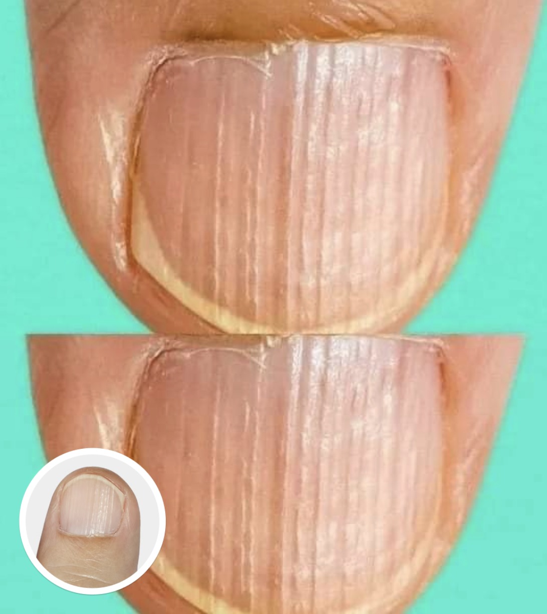What It Means When You Notice Ridges on Your Fingernails