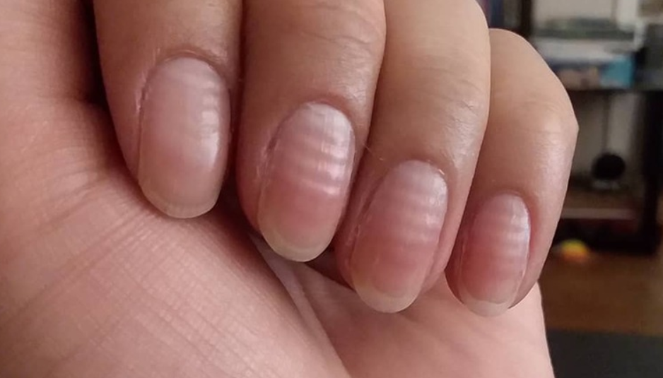 What Vertical Ridges on Your Nails Really Mean