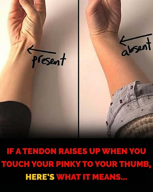 An Easy Way to Identify a Vestigial Arm Tendon