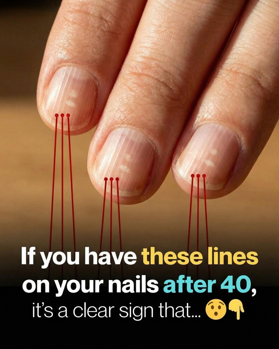 Vertical Nail Ridges: Why They Happen More as You Get Older