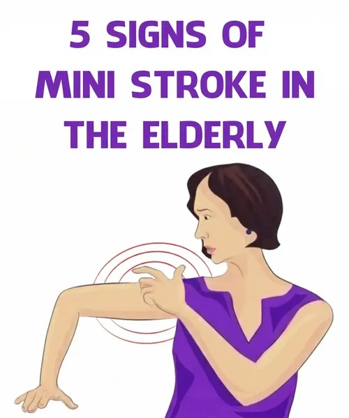 Spotting Mini-Stroke Symptoms in Seniors Before They Vanish