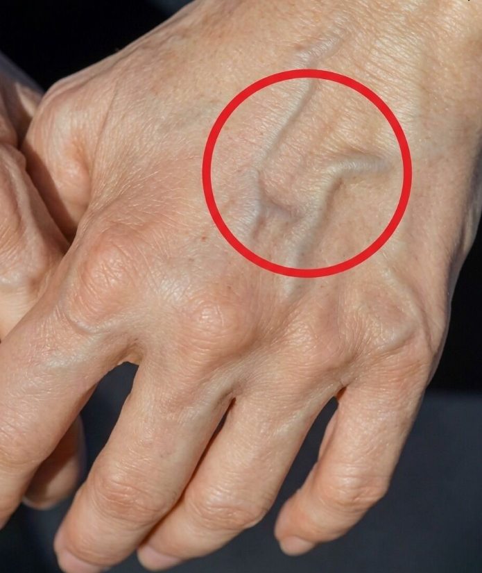 Are the Veins on Your Hands Telling You Something About Your Kidneys?