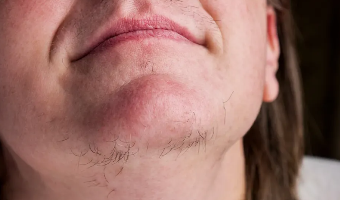 Why Chin Hair Grows in Women and What It May Indicate