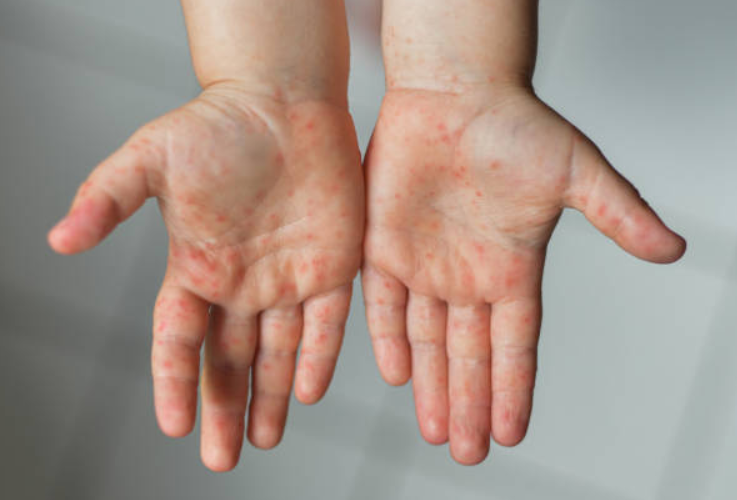 Forest Hike Surprise: A Close Look Reveals the Truth Behind Tiny Skin Irritations