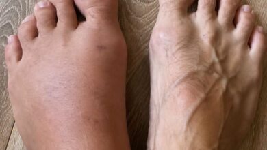 Swollen Feet and Ankles: Common Causes, Simple Care Tips, and When to Seek Advice