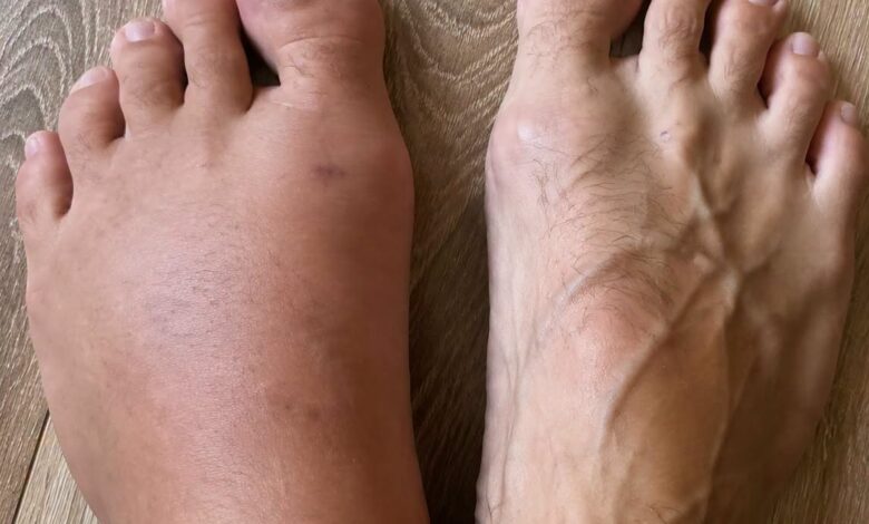 Swollen Feet and Ankles: Common Causes, Simple Care Tips, and When to Seek Advice